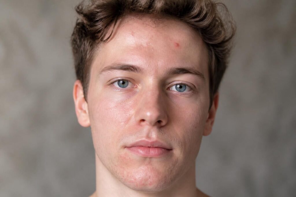 Boutons sur le menton et le front : que révèlent les zones du visage ?